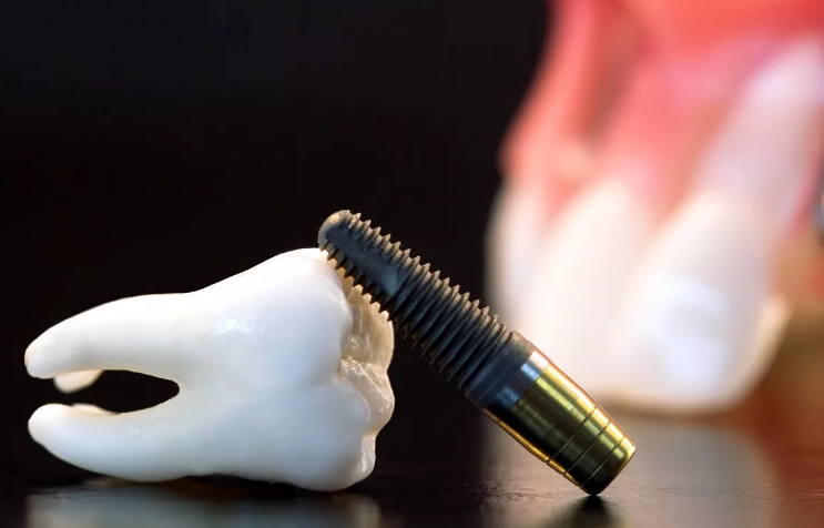 Что нужно знать про зубные имплантаты?