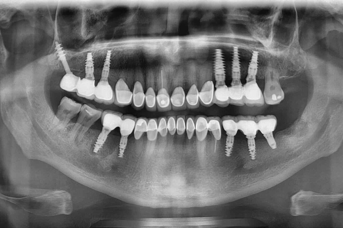 Панорамный снимок зубов: что это, зачем он нужен и как его сделать