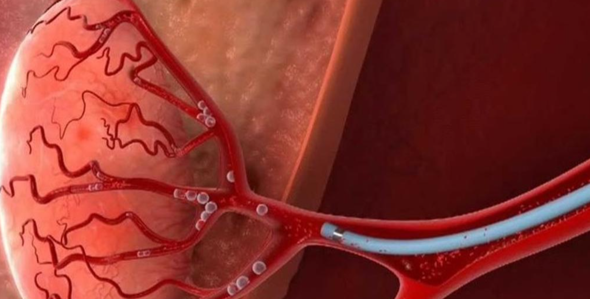 Эмболизация маточных артерий: что это такое и зачем она нужна