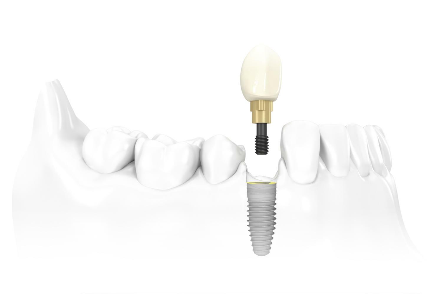 Импланты Replace Select — инновационное решение для восстановления зубов