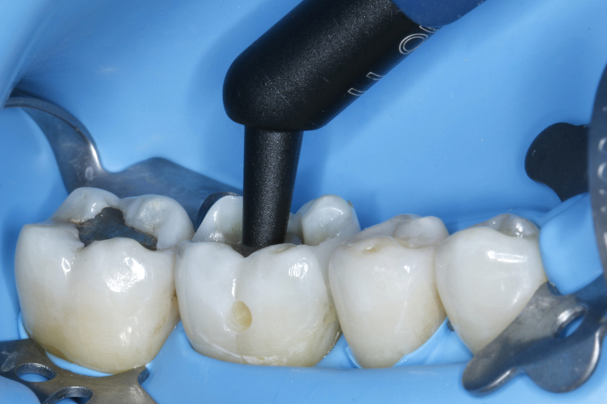 Почему важно вовремя запломбировать зуб
